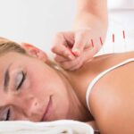 dry needling 2